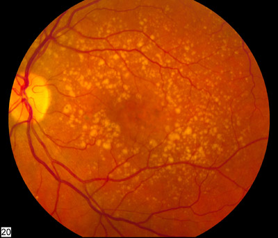 Intermediate age-related macular degeneration Intermediate age-related macular degeneration